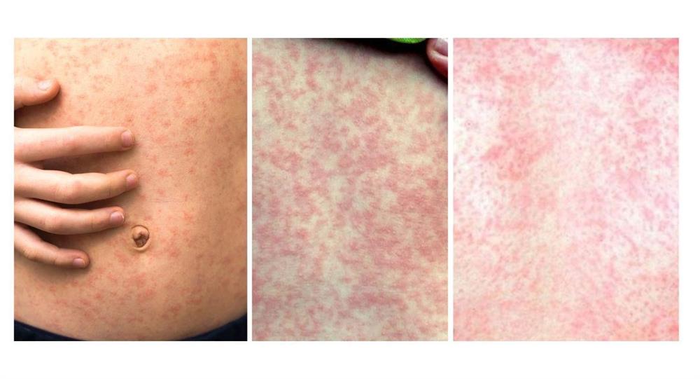 Chẩn đoán và điều trị sởi